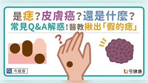 為什麼痣會長毛|是痣？皮膚癌？還是什麼？常見Q&A解惑！醫教揪出「。